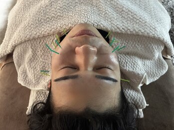 門司駅やわらぎ鍼灸整骨院/美容鍼