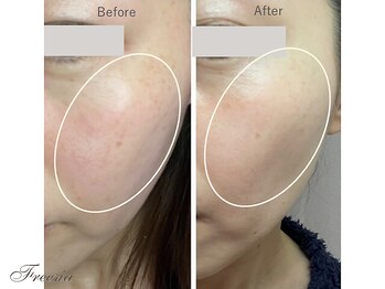 フリージア(Freesia)の写真/【大人女性の美肌作り♪】ヒト幹細胞×シミケアで、年齢を感じさせない”ハリ・艶・潤い”のあるお肌に!