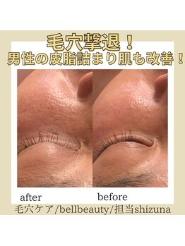 ベルビューティー(belle beauty)/毛穴洗浄☆お客様の結果！