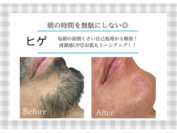 アルゴ 熊本玉名店(ALGO)/【ヒゲ】劇的ビフォーアフター
