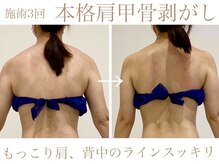 本格肩甲骨剥がし!!もっこり肩、巻き肩、姿勢改善☆