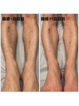 エクリア(ECLIA)/メンズ脱毛/足全体脱毛