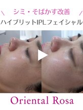 オリエンタルローザ 表参道(Oriental Rosa)/シミ・くすみ改善医療提携で◎