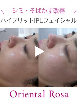 オリエンタルローザ 表参道(Oriental Rosa)/シミ・くすみ改善医療提携で◎