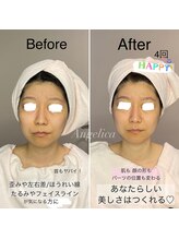 アンジェリカ(Angelica)/気になるほうれい線やゆがみ