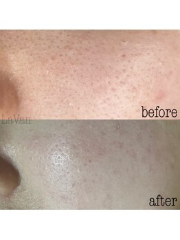 ラヴァン(LaVan)/毛穴ケア&美白