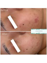 クレア(Clair)/アンストレス症例