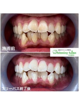 ホワイトニングサロン 名古屋駅店/【ホワイトニング施術例】