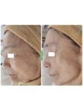 アップル 御幸ヶ原店(Apple.)/肌改善プログラム