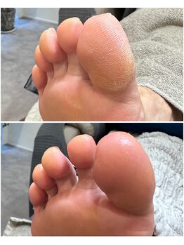 ケアプラス(care plus)/足裏角質ケア