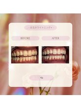 プラスビー 2号店(+b)/ホワイトニングビフォーアフター