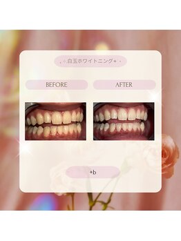 プラスビー 2号店(+b)/ホワイトニングビフォーアフター