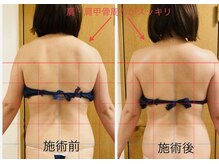 コストマリー/肩こり背中のむくみスッキリ