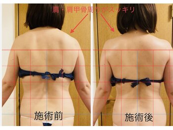 コストマリー/肩こり背中のむくみスッキリ