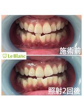 ルブラン 奈良店(Le Blanc)/タバコのヤニもスッキリ！！