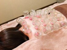 アルバ暁子鍼灸治療院(alba暁子鍼灸治療院)/吸い玉（カッピング）