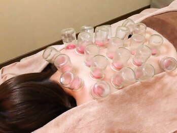 アルバ暁子鍼灸治療院(alba暁子鍼灸治療院)/吸い玉(カッピング)