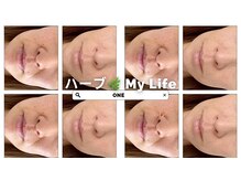 ワン(ONE)/ハーブピーリング