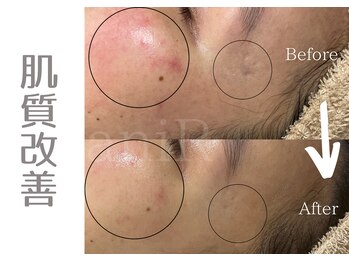 アニール(aniR)/ハーブピーリング/フェイシャル