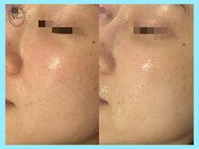 ヴィオール 名古屋栄店(VIOR)/TETEピール　酸性の力で毛穴改善