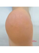 レフス 北参道店(REFUSS)/本格角質ケア