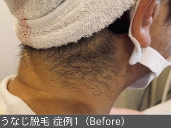 オアシスラグーン(OASIS LAGOON)/うなじ脱毛(症例1 before)