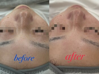 ファーファラ(Farfalla)/毛穴洗浄