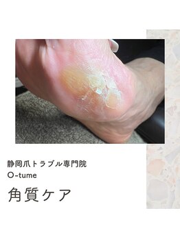 オツメ 静岡(O-tume)/角質ケア
