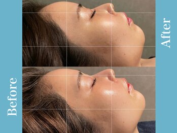 イーヴ(Eave)/水光ジェット/韓国美容/小顔効果