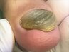 【足の爪切りセット】分厚い爪・深爪 補正 1指¥6,600~