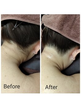 サロン ピューパ(Salon pupa)/うなじ　before →after