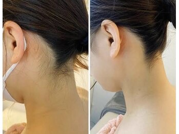 バニスティ 鶴岡店/脱毛で見せるうなじへ♪