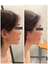 シュシュ(chouchou)/小顔矯正　60分