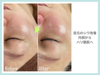 リラクゼーションアンドビューティーボヌール(BONHENR)/最新☆ラミネーションピーリング