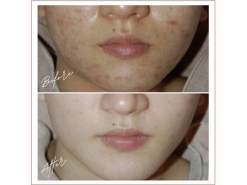 ミューベル(MYubelle)/透明感美白 水光ピーリング