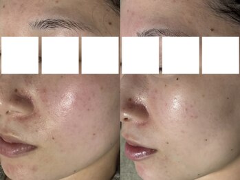 リボーン(REBORN)/ハーブピーリング