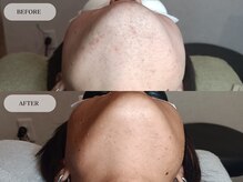 メンズプラス(MEN’S PLUS)/ヒゲ脱毛/ビフォーアフター写真