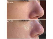 毛穴の黒ずみ、開き毛穴、たるみ毛穴。長年のお悩みも解決！