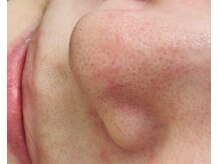 毛穴が気になる方に新しいメニューの誕生です！