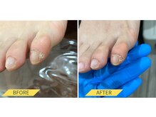 ふっとけ庵/副爪ケア