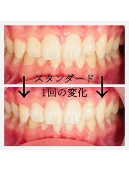 シエル(CIEL)/美容ジェルセルフホワイトニング