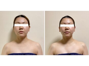 ニコワ(Nicowa)/Nicowaのコルギ★BeforeAfter