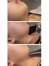 インフィニティ ビューティサロン 姫路店(INFINITY beautysalon)/レモンボトル