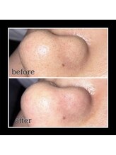 メンズ脱毛 リボーン(reborn)/黒ずみスッキリ