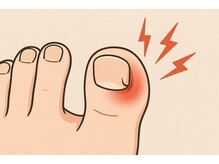 巻き爪じゅん 千葉駅前店/ &nbsp;巻き爪を放置すると重くなる