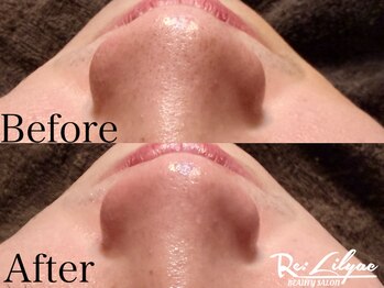 リリアック(Re:Lilyac)/Re:ilyac#毛穴洗浄