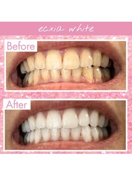 エクシアホワイトニング 大府店/ホワイトニングビフォーアフター