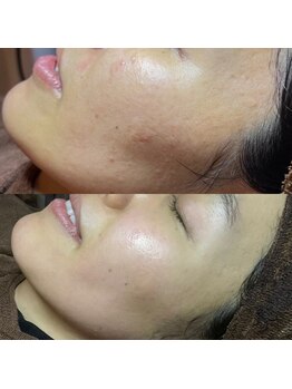 ホワラ 横浜店(Whila)/施術効果１