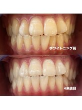 ホワイトニングビューティー 行橋店/ホワイトニング途中経過