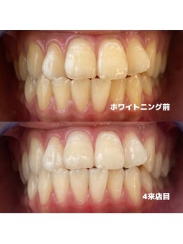 ホワイトニングビューティー 行橋店/ホワイトニング途中経過